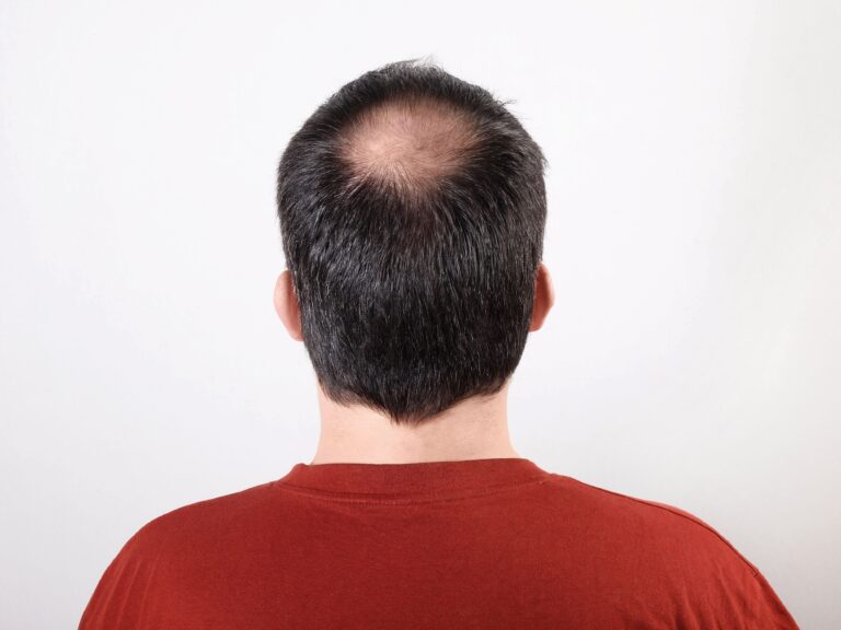 What causes rapid baldness?/maxaa sababa bidaarta degdega ah..
